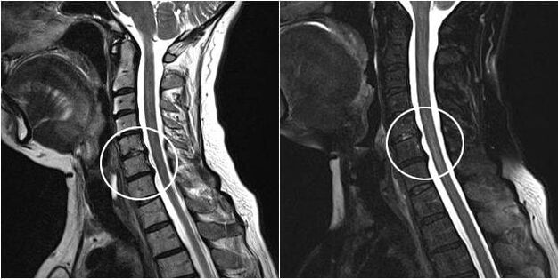 MRI της αυχενικής μοίρας της σπονδυλικής στήλης με σημεία οστεοχονδρωσίας
